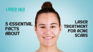 Laser Treatment for Acne Scars