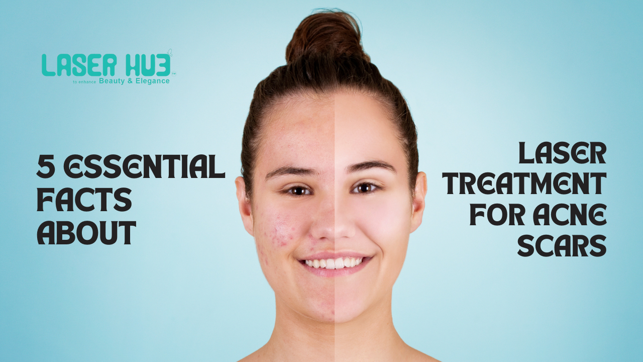 Laser Treatment for Acne Scars