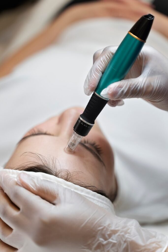 Microneedling (Vampire Facial)